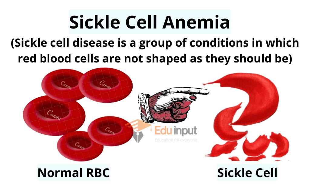 image showing mutation in blood cell (sickle cell anemia)