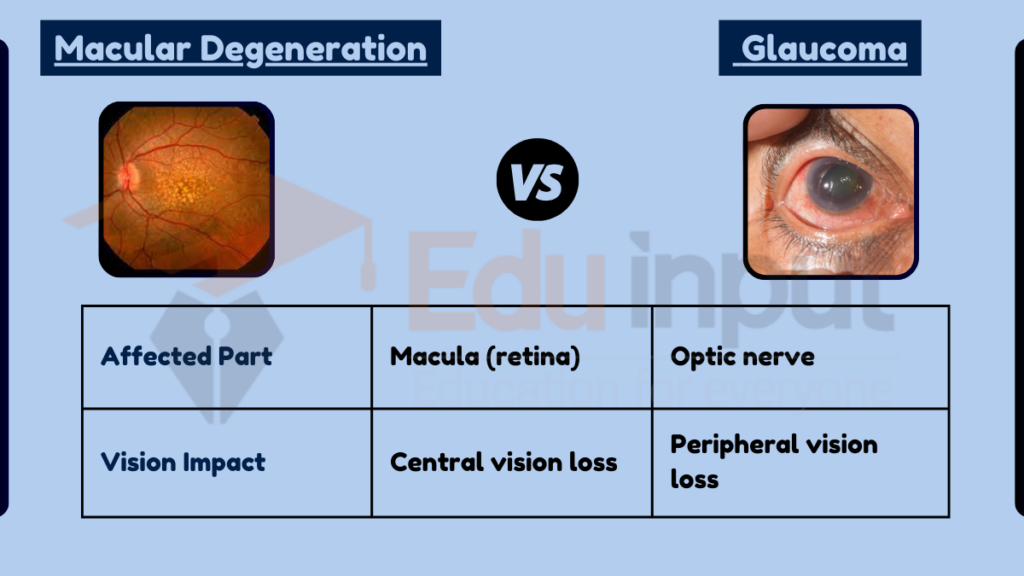 image showing  Difference Between Macular Degeneration and Glaucoma