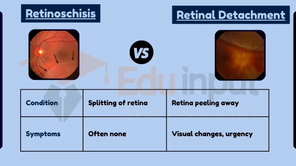 image showing Difference Between Retinoschisis and Retinal Detachment