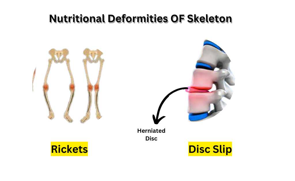 image showing Nutritional Deformities